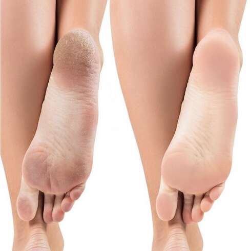 Soin bien-être Soin anti callosité +1er pose vernis semi permanent pieds